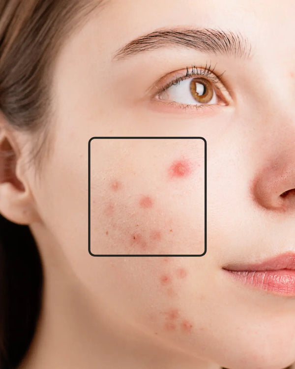 Acne Marks