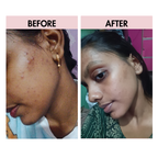Anti Acne Cream 30gm | Pimple Control & Acne Spot Reduction Cream Divine Era Herbal