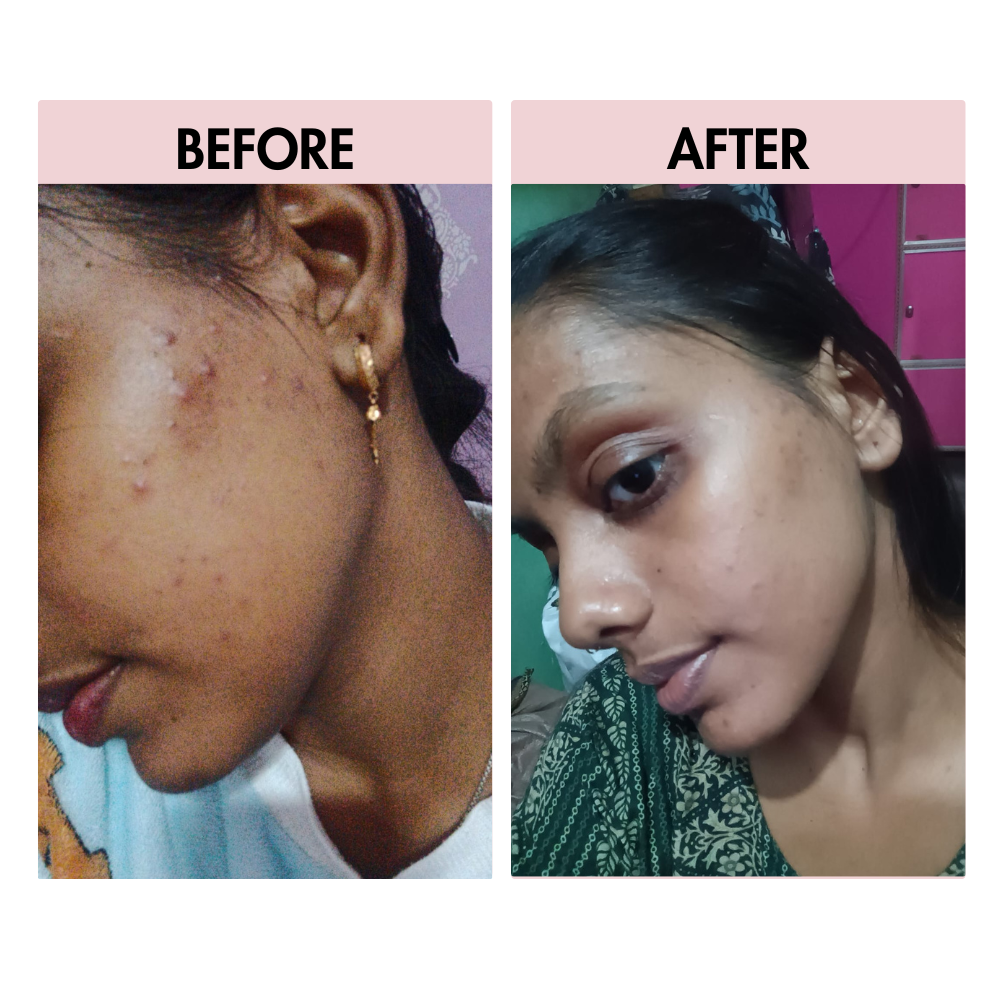 Anti Acne Cream 30gm | Pimple Control & Acne Spot Reduction Cream Divine Era Herbal