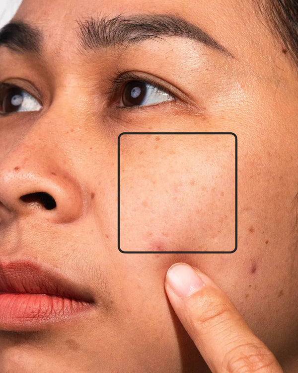 Dark Spots