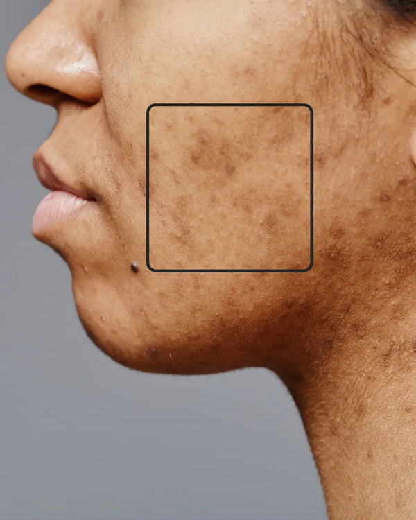 Pigmentation