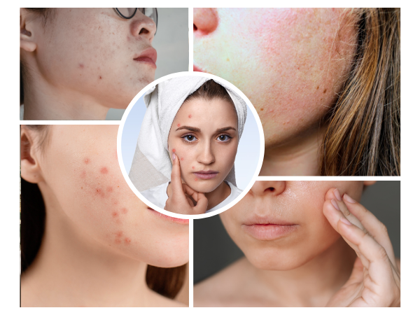 Acne cream for woman made with natural Ayurvedic ingredients to reduce pimples, acne marks, and promote clear glowing skin