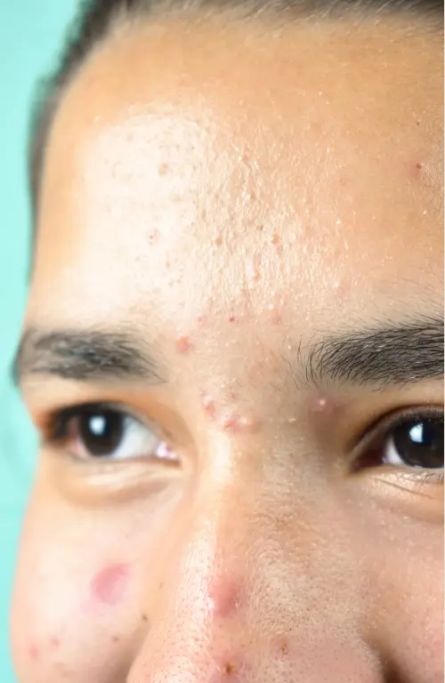 Best acne cream for face helping reduce acne, pimples, and dark spots for clear and healthy skin