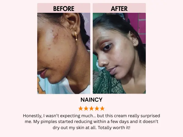 Acne cream review (2)