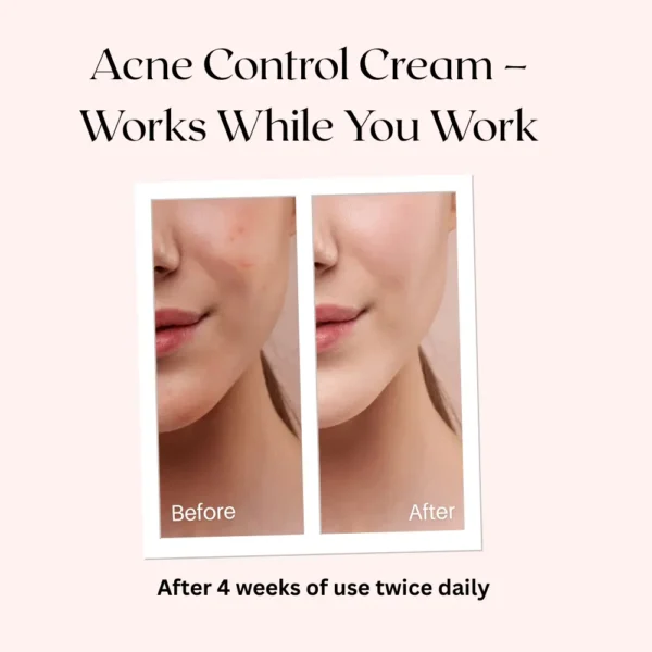 Before-and-after image showing significant reduction in acne and redness on a woman's cheek after using the Divine Era Acne Control Cream for 4 weeks, twice daily. The text says: "Acne Control Cream - Works While You Work."