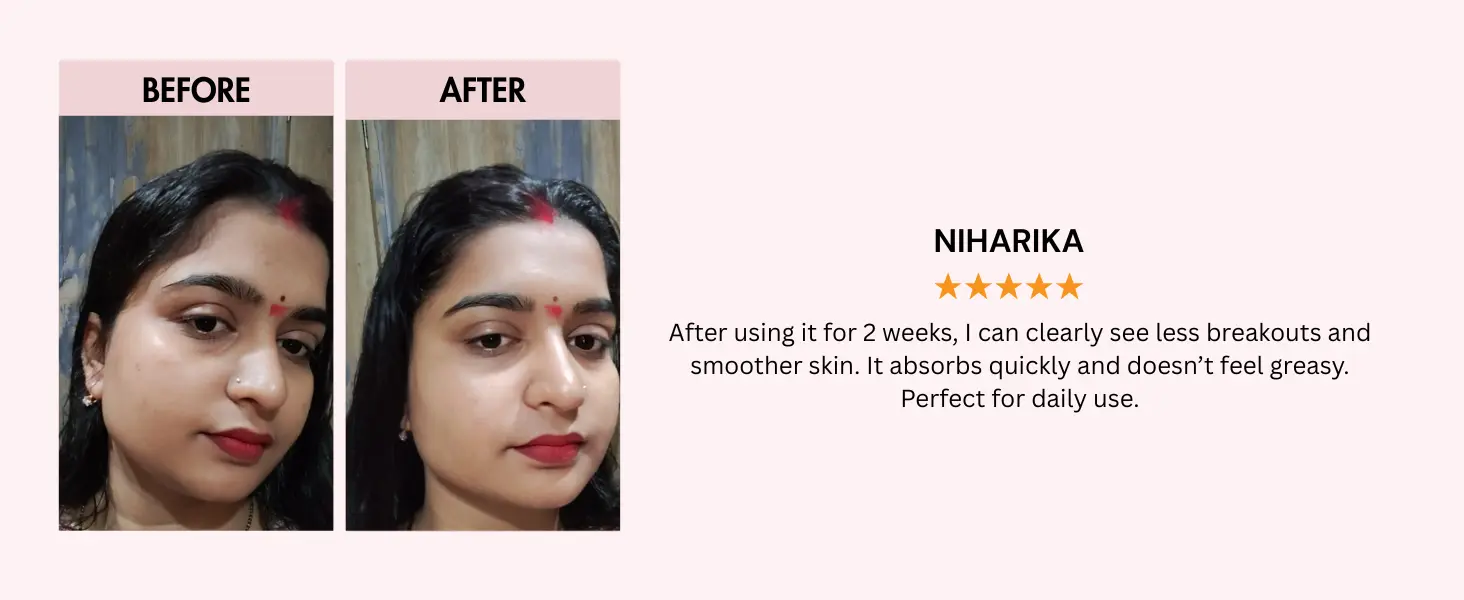 Natural acne cream for pimple