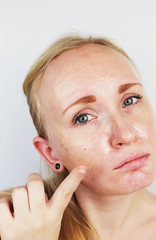 Acne cream for woman helping to control oily skin, reduce excess sebum, and prevent acne and pimples