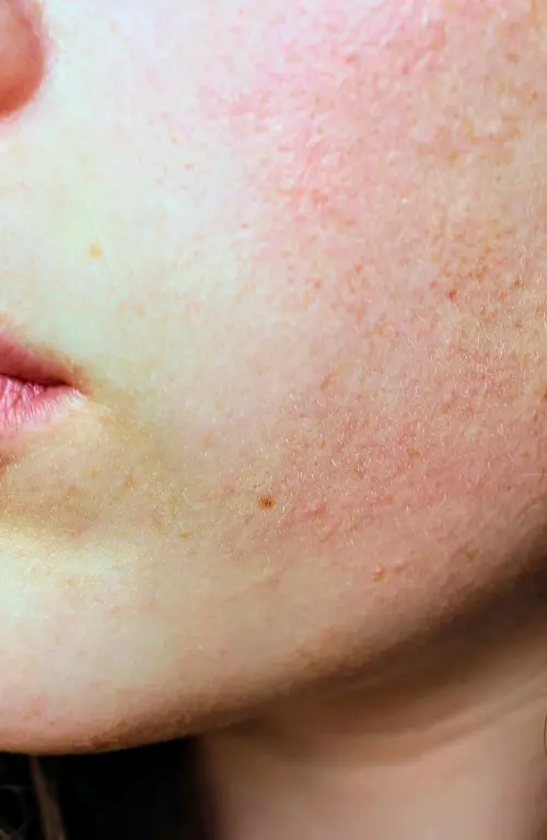 Best acne cream for face helping to reduce skin redness, irritation, and acne for calm and clear skin